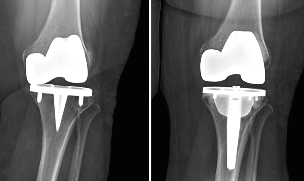 Best knee replacement hospitals in india