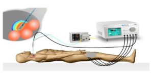 Radiofrequency Ablation cost in india
