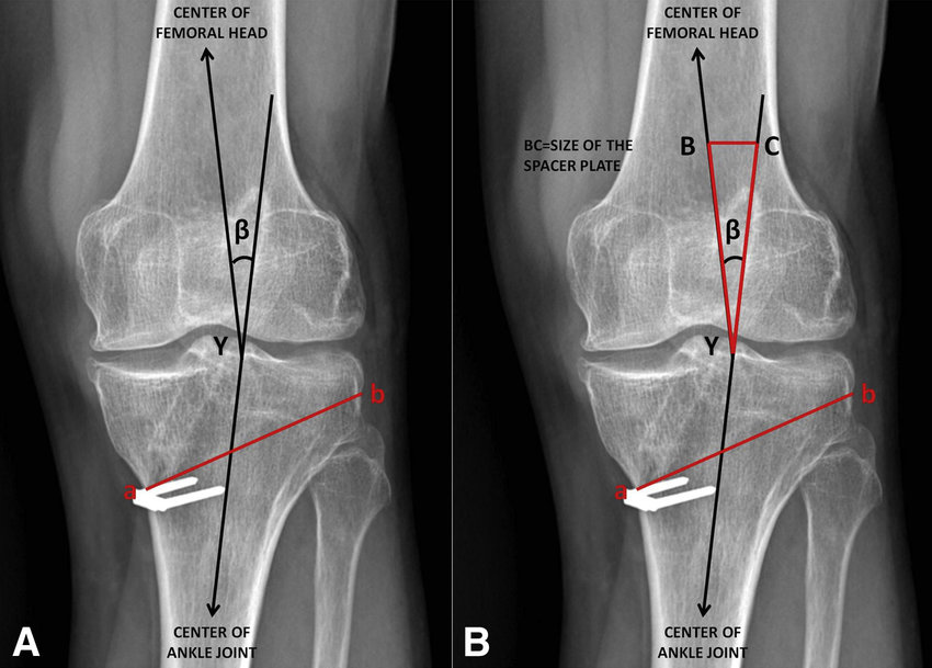 High Tibial Osteotomy to avoid arthrosis of knee at the least cost in India