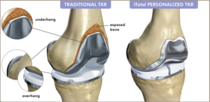 knee replacement surgeon in india