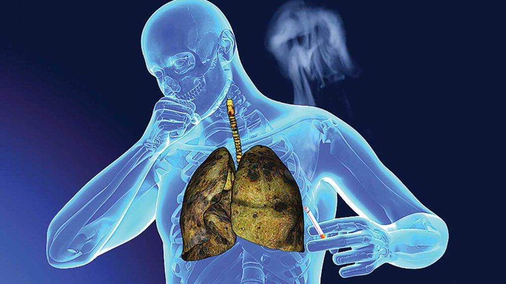 What is the Treatment for Lung Cancer