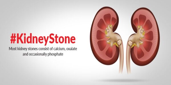 How to Diagnose Kidney Stones