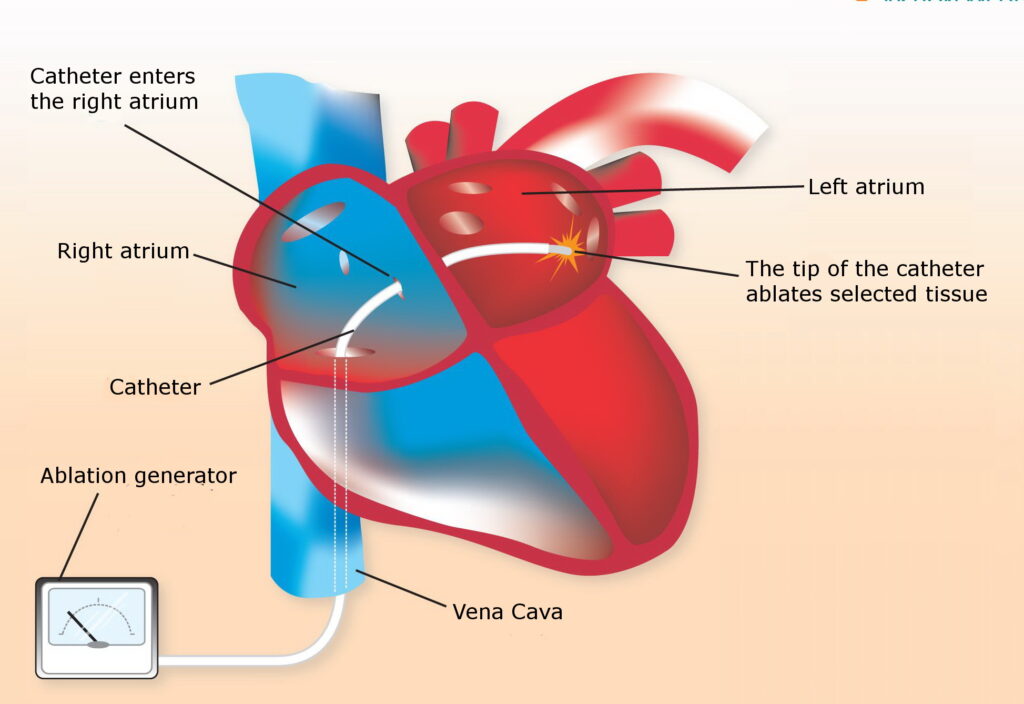 cardiac catheter ablation