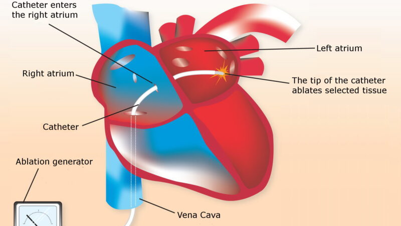 Accentuating Cardiac Ablation