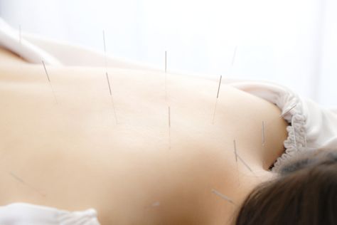 Acupuncture St Jerome