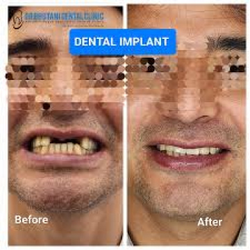 Dr Bhutani Dental Clinic | Dentist in Gurgaon | Best Dental Clinic in Gurgaon
