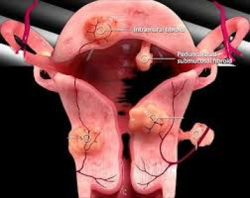 Advanced Uterine Fibroid Embolisation for Safe Relief