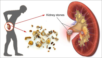 Kidney Stone Treatment in Pune