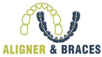 Aligner and Braces: Best Dental Clinic in Delhi | Braces & Invisible Braces, Teeth Whitening in Delhi