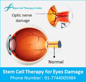 Stem cell therapy for eyes in India