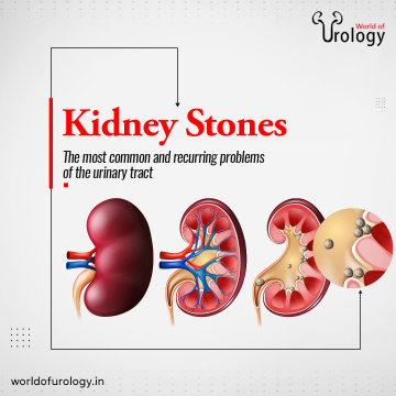 Best Urologist For kidney Stones In Bangalore | Worldofurology
