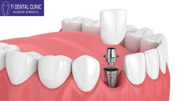 The Importance of Bone Grafting for Dental Implants