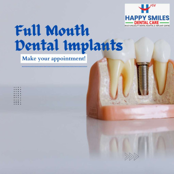 Full Month Dental Implants – Your Complete Guide to a Permanent Smile