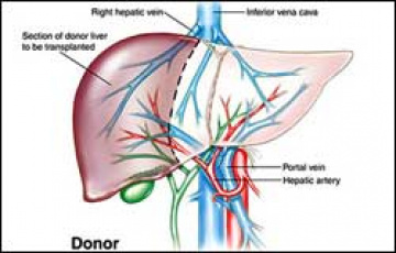 Low cost liver transplant in india by Transplantliverindia