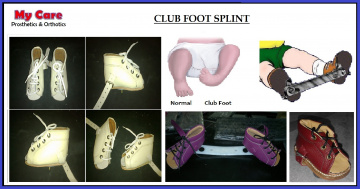Clubfoot Shoe CTEV Splint
