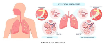Advanced Bronchoscopy Services in India by Lung Specialists – Asthma Bhawan