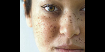 Best Dark Circles Treatment in Bangalore| Skin Specialist - Dr.Health Clinic
