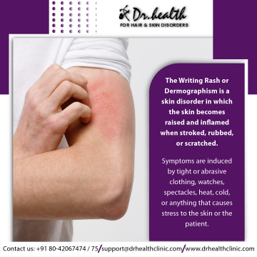 White Patches Treatment in Bangalore | Vitiligo Treatment- Dr.Health Clinic