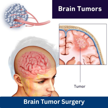 Affordable Brain Tumor Surgery in India