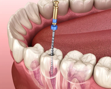 Expert Root Canal Treatment in Ahmedabad | The Dental Wellness Centre