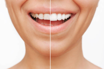 Smile Makeover Coimbatore
