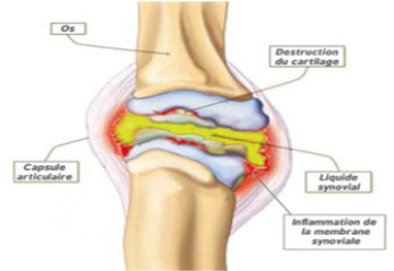 Arthritis Treatment In Pune | Best Ayurvedic Treatment