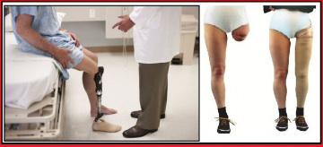 Prosthetics (Artificial Legs & hands)