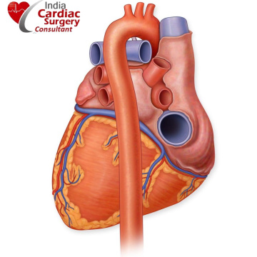 Best Endovascular Aneurysm Surgeons India