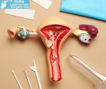 Top Laparoscopic Myomectomy Specialists in India