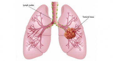 Best Lung Cancer Treatment in India