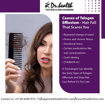 Alopecia Areata | Alopecia Areata Treatment in Bangalore- Dr. Health Clinic