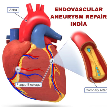 Endovascular Aneurysm Repair India