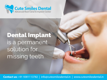 Cute Smiles Dental - Advanced Root Canal treatment, Implant Center, Wisdom tooth removal, Best dental clinic in Bangalore