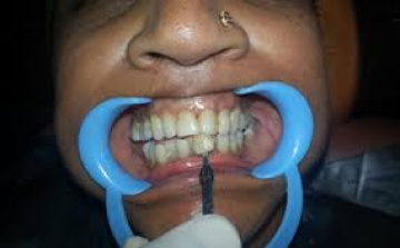 Smile Design Coimbatore
