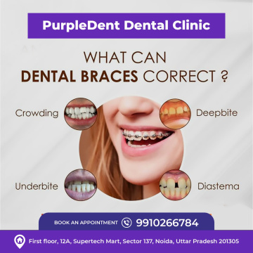 Dental Checkup in Noida PurpleDent Dental