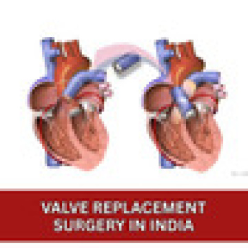Valve Replacement Surgery Cost in India