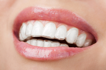 Choosing the Right Care: Dental Implants in Chennai